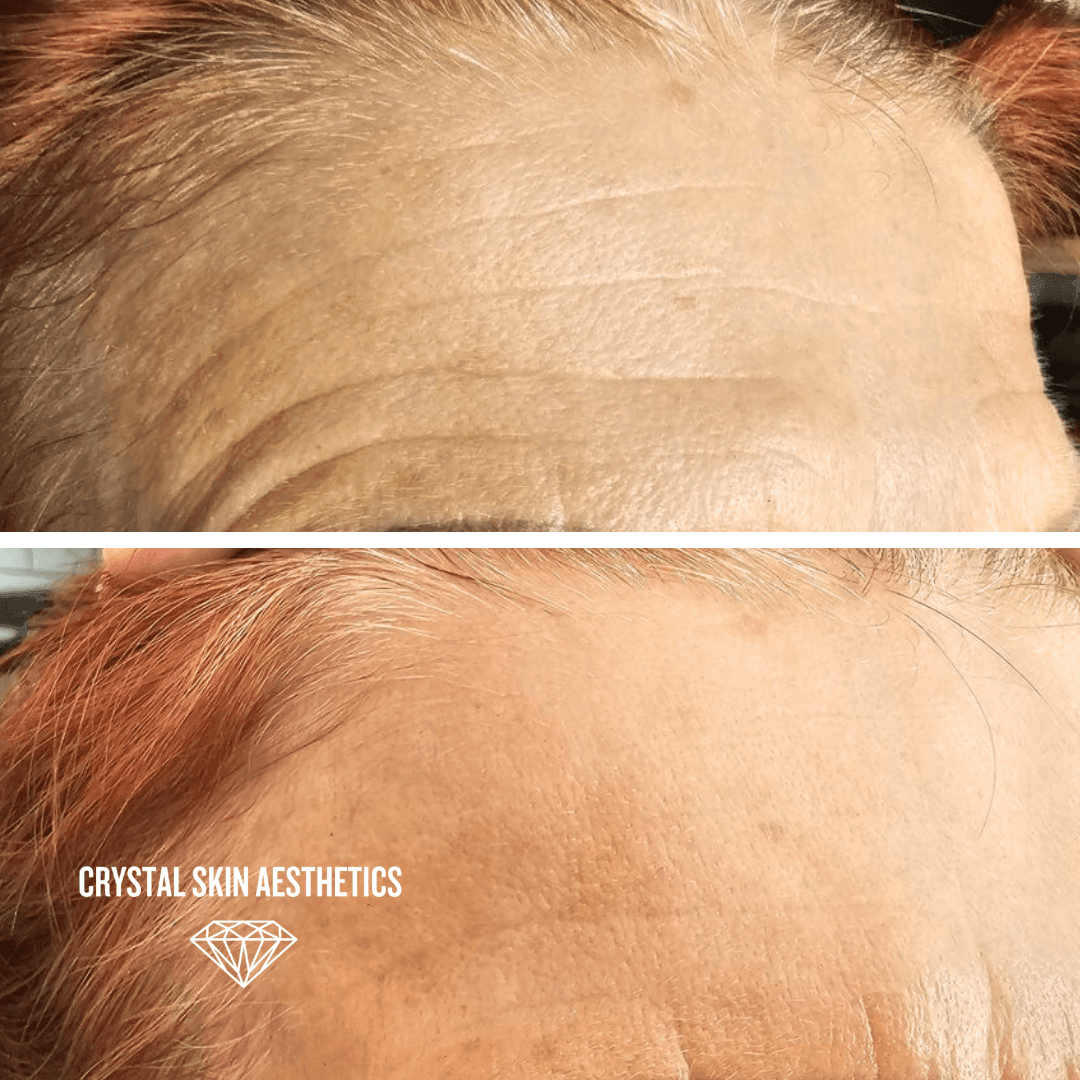 Anti Wrinkle