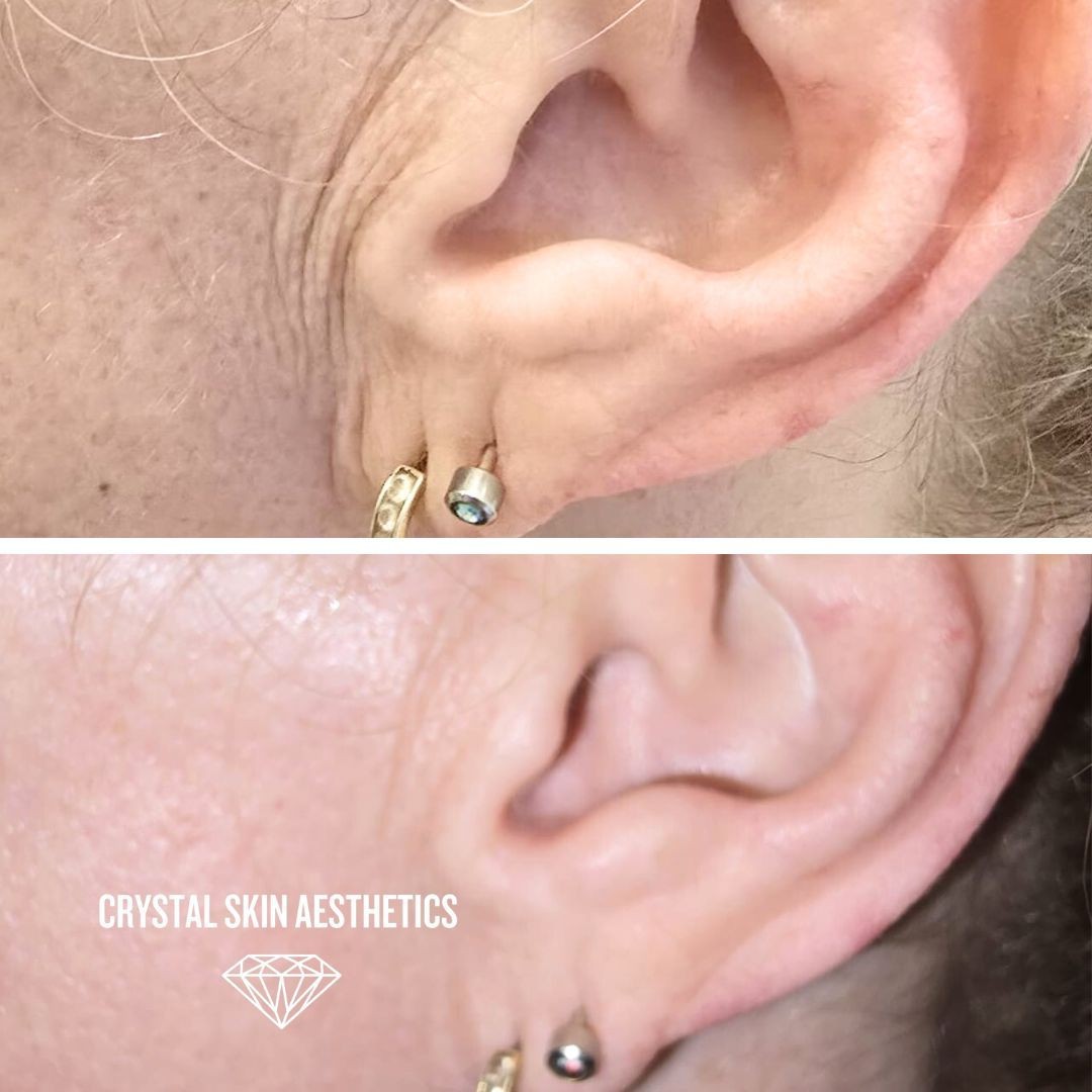 Skin Rejuvenation