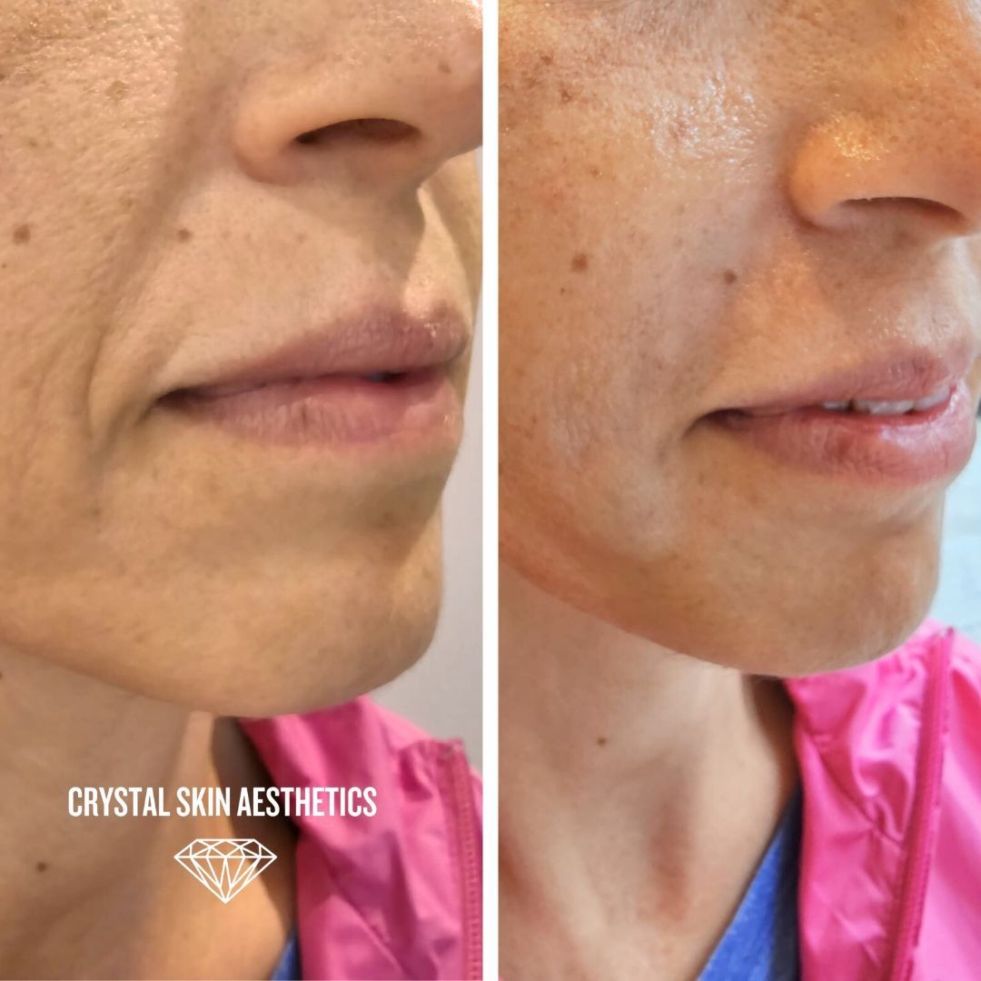 Nasolabial Folds & Marionette Lines