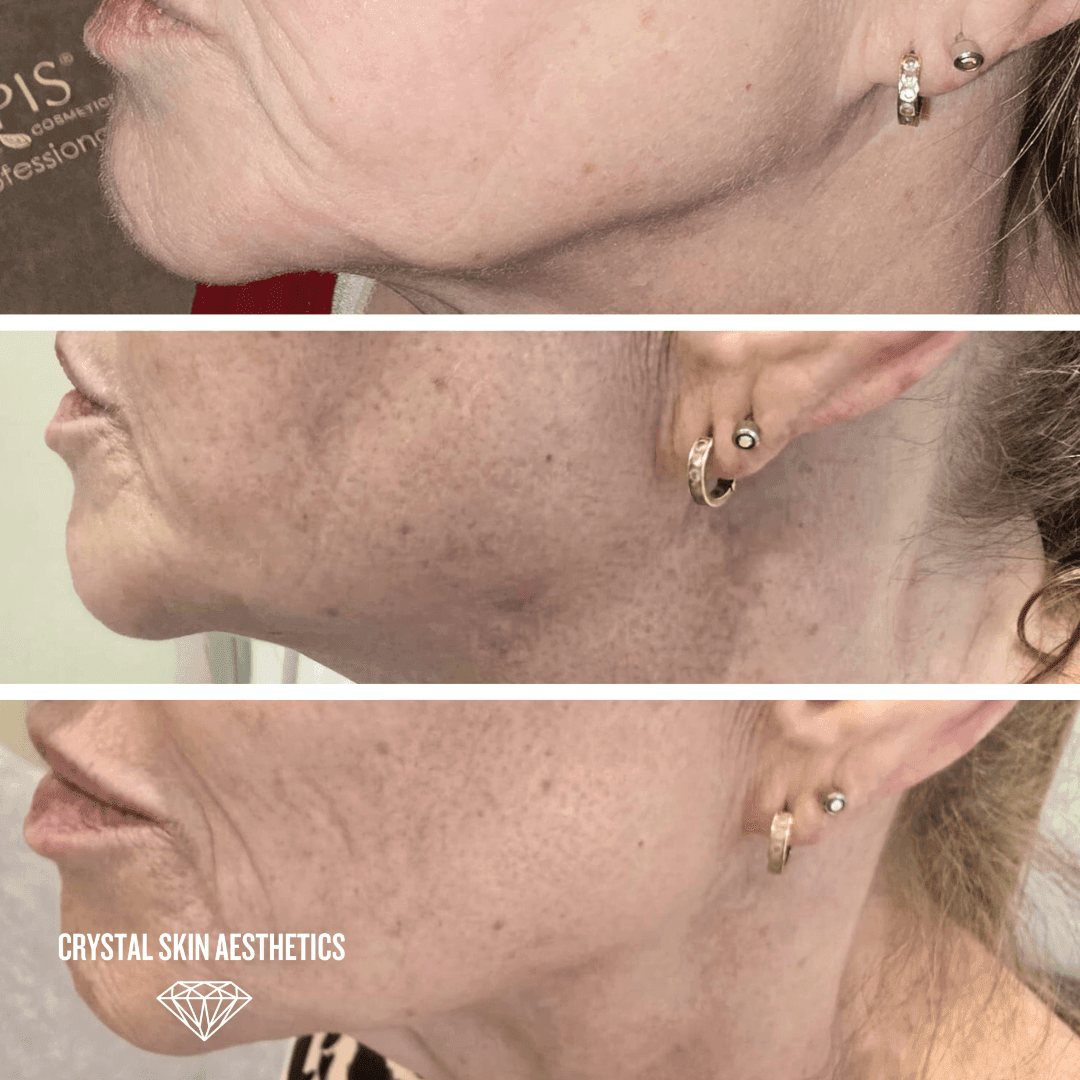 Jawline Tightening