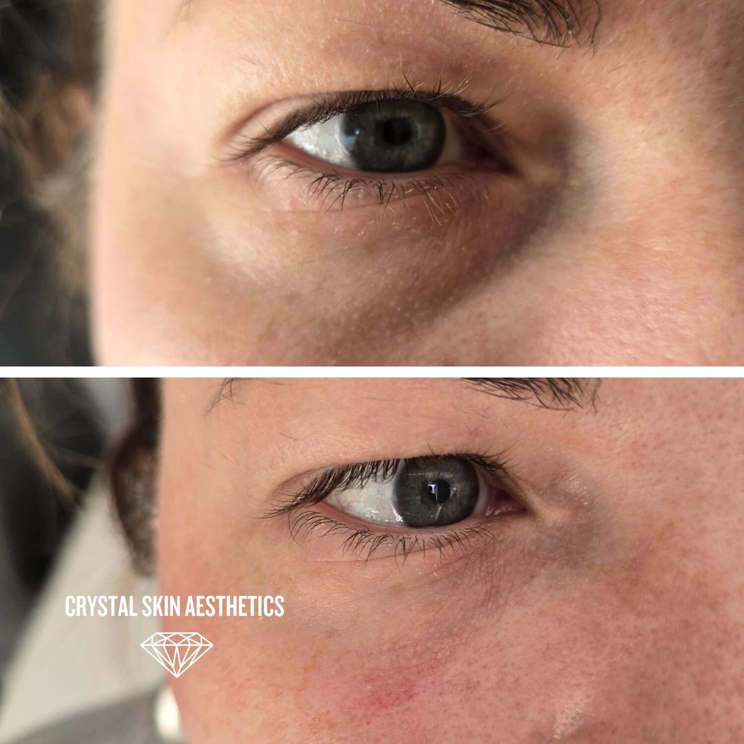 Eye Rejuvenation