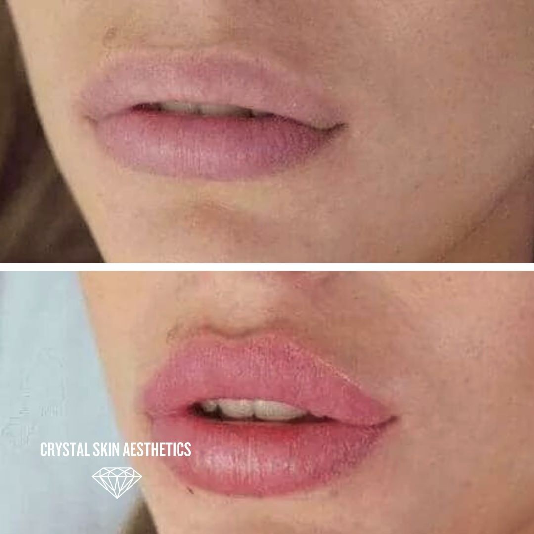 Lip Enhancement