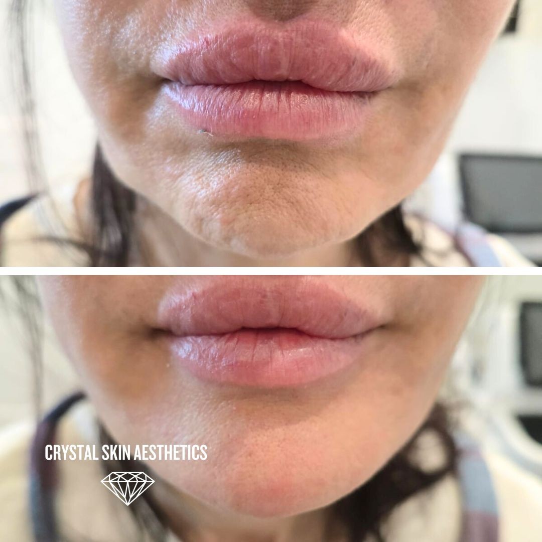 Chin & Jawline Augmentation
