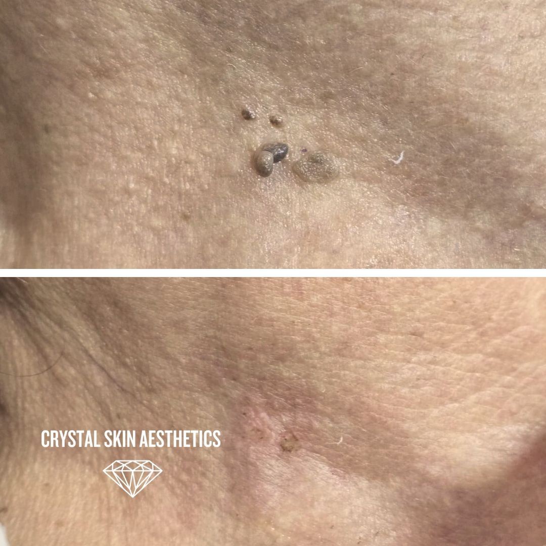Skin Tag Removal