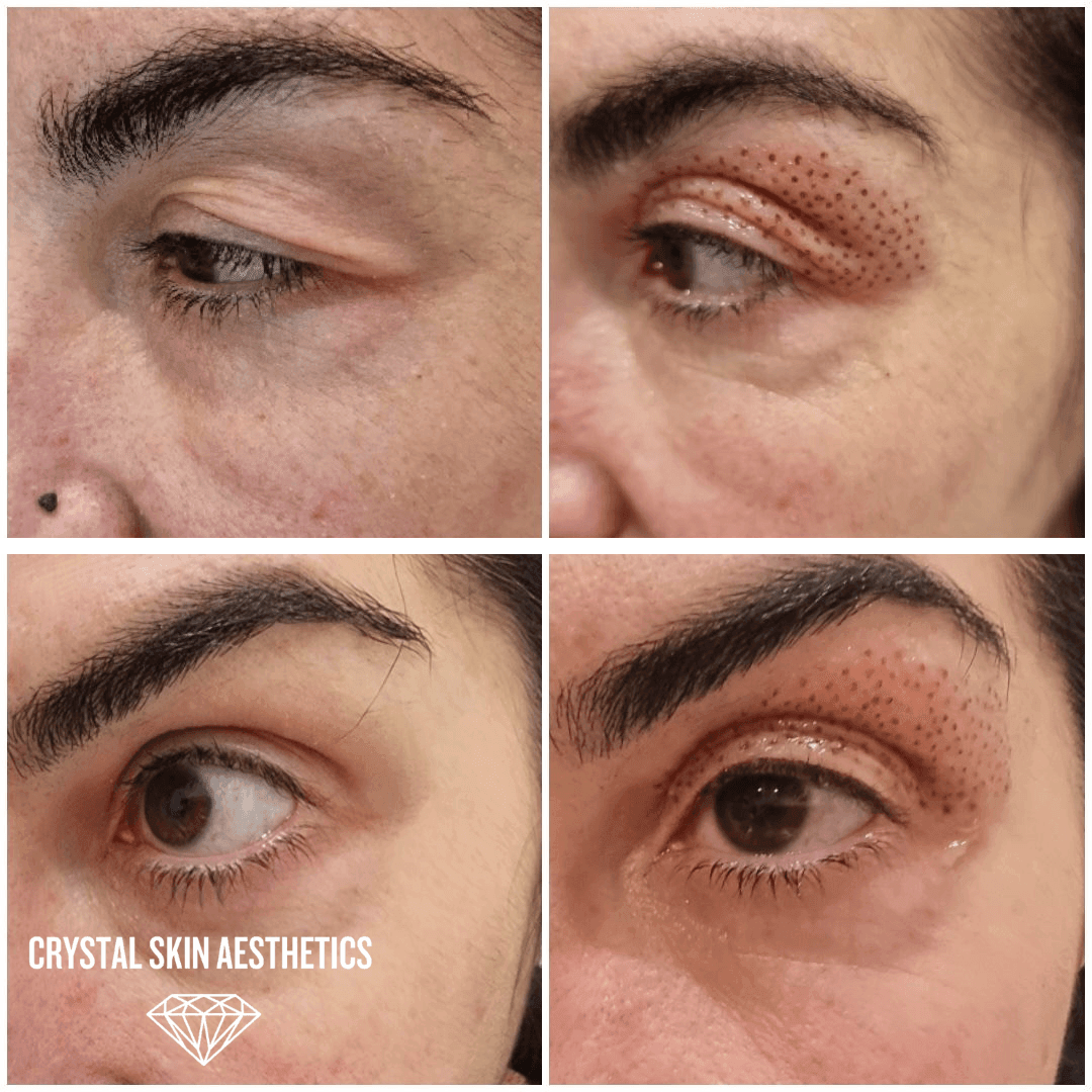 Hooded Eye Reduction