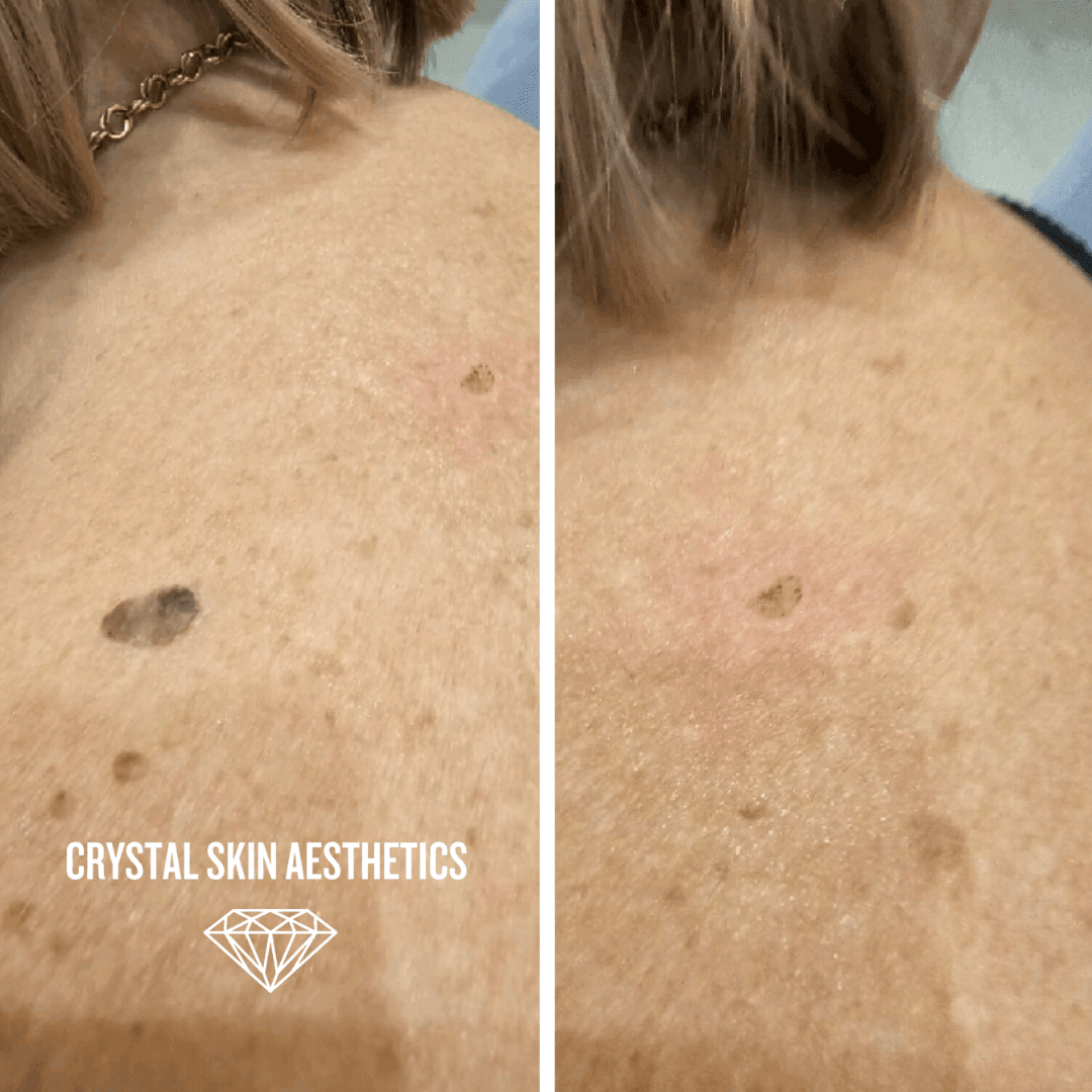 Mole Removal
