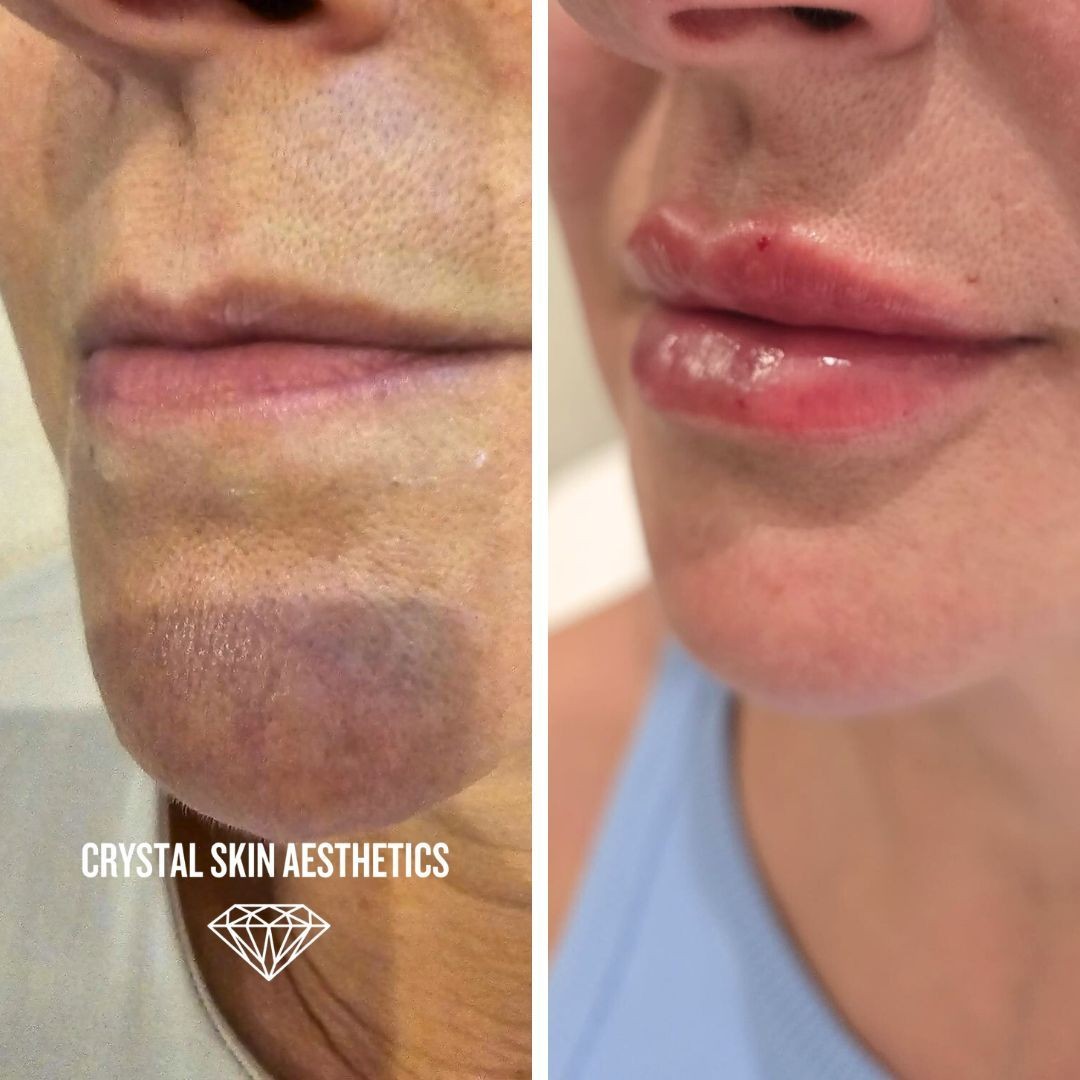 Lip Enhancement
